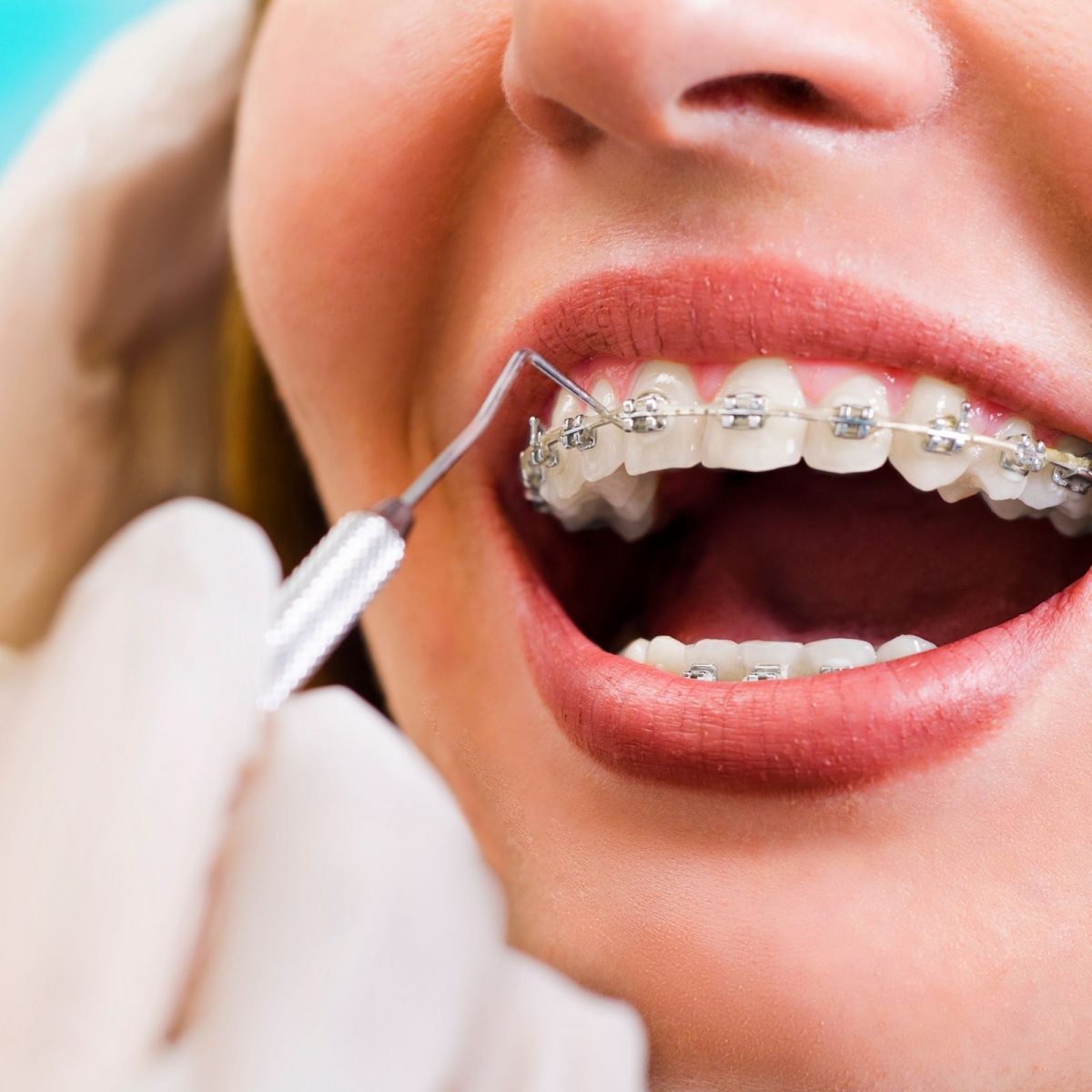 Medicina Dentária - ORTODONTIA (APARELHOS)