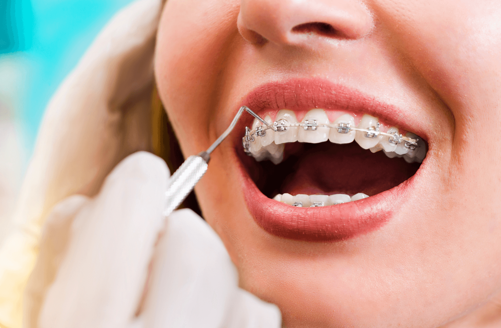 Medicina Dentária - ORTODONTIA (APARELHOS)